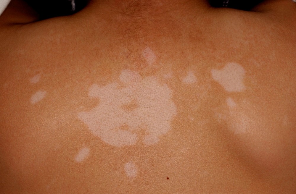 gyulladásos bőrbetegségek
