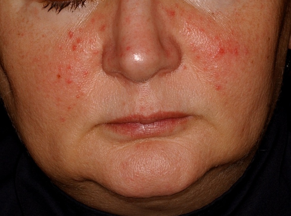 Prosztata kezelés az arcon - Milyen tünetei lehetnek a nyirokérgyulladásnak?